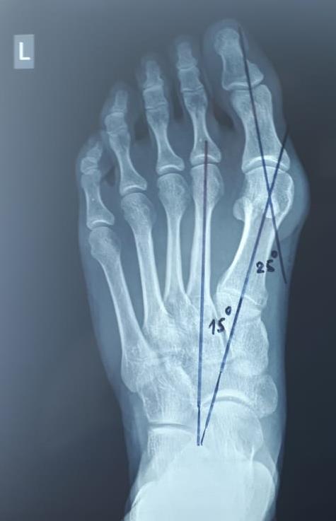косточка на большом пальце рентген 8