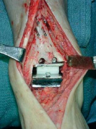 Операция артроза голеностопного сустава
