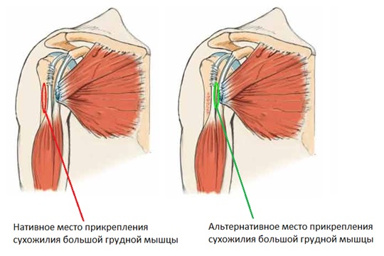 Лечение частичного разрыва мышц. Отрыв сухожилия большой грудной мышцы. Реинсерция сухожилия грудной мышцы. Операция на сухожилие грудной мышцы. Разрыв сухожилия грудной мышцы.