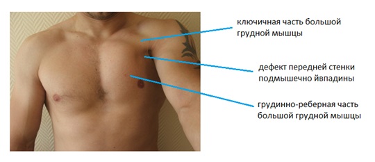 Почему левое больше правого. Разрыв мышц грудной клетки. Растяжение большой грудной мышцы.
