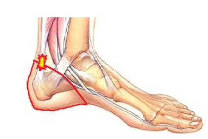 Болит нога после операции пятки