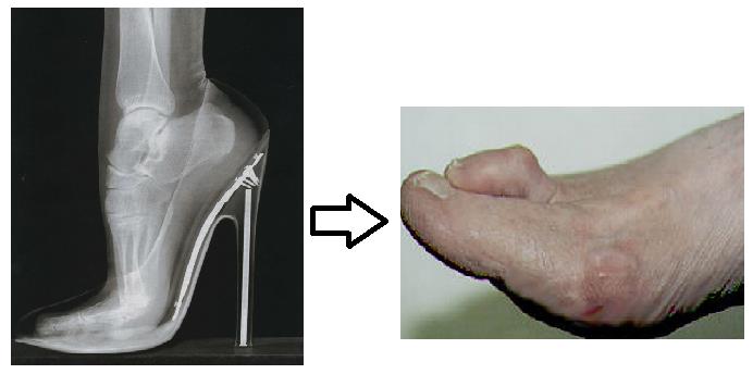 Молоткообразный палец на ноге оперативное лечение