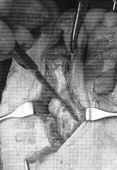 Молоткообразный палец на ноге оперативное лечение