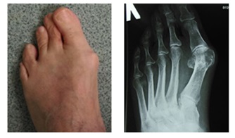 косточка на большом пальце ноги до операции