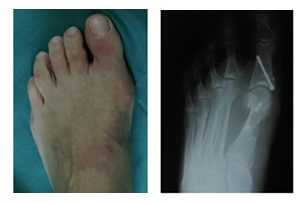 косточка на большом пальце ноги после операции