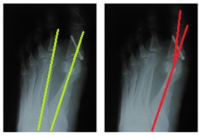 косточка на большом пальце ноги рентген после операции
