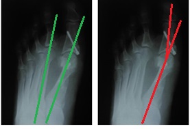 косточка на большом пальце ноги рентген после