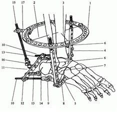           
Использование аппарата Илизарова при переломах пяточной кости.
