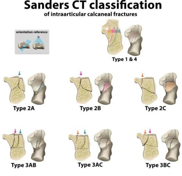 Классификация переломов пяточной кости Sanders  