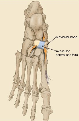 Отрывные переломы ладьевидной кости