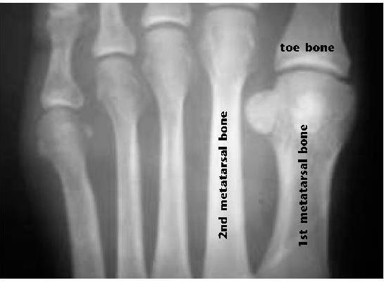 Операции артроза на косточке ноги