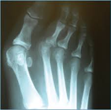 Артроз большого пальца стопы оперативное лечение