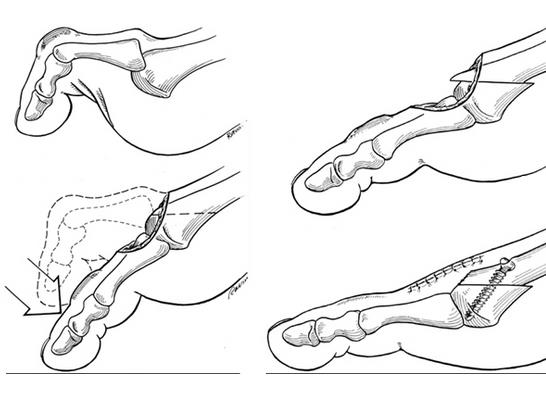 Артропластика стопы и пальцев ноги что это