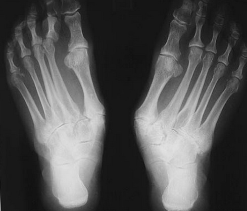 Операция артроз пальцев стопы