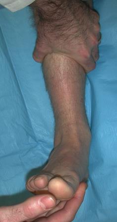 Перелом лодыжки с синдесмозом оперативное лечение