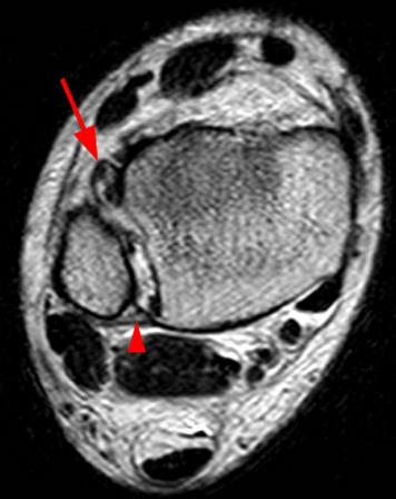 Перелом малоберцовой кости с разрывом связок