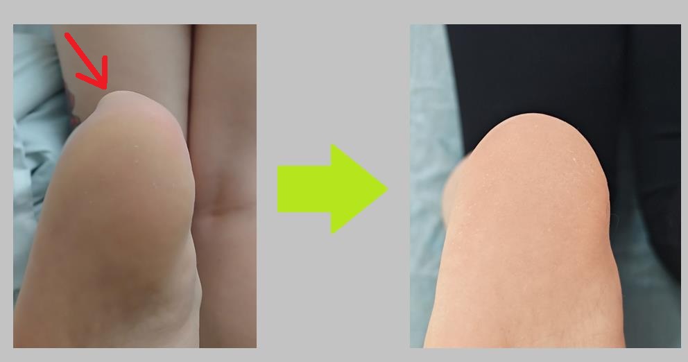 До и после — Болезнь Хаглунда, операция от 25.12.2025